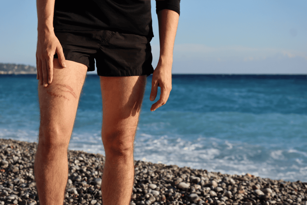 Jellyfish stings in cornwall