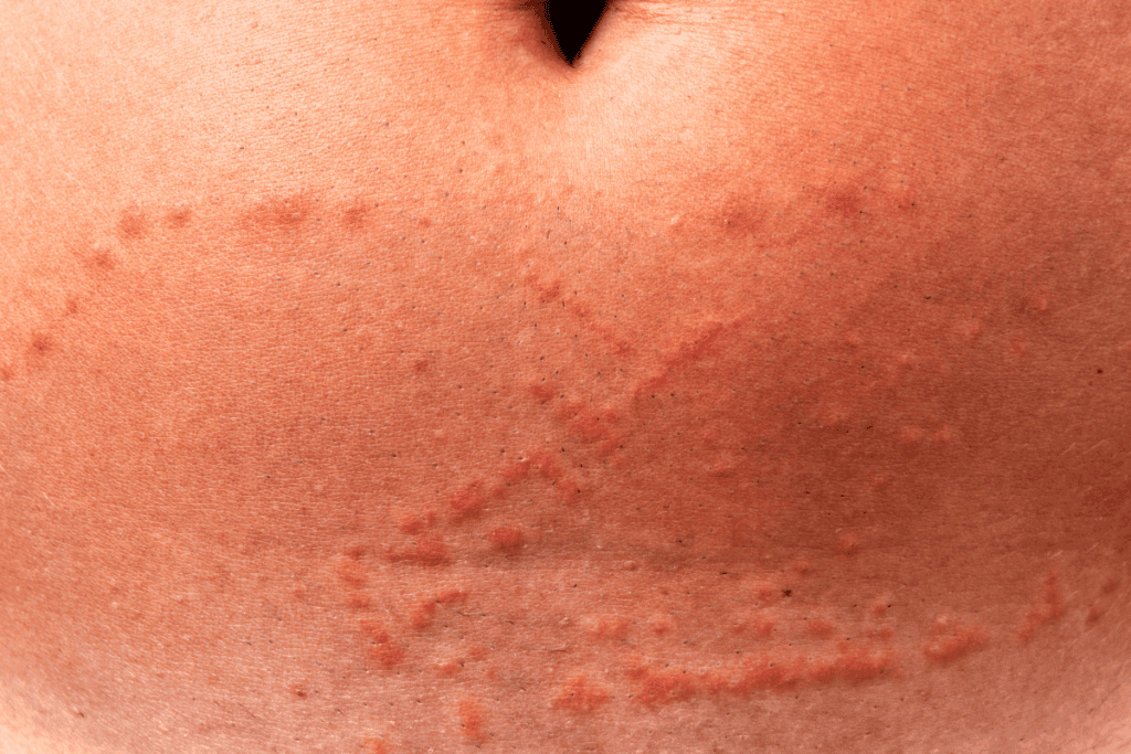 what does a jellyfish sting look like